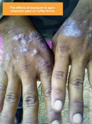 Chemical Burns on a Farmworkers Hands - Fyffes Farm